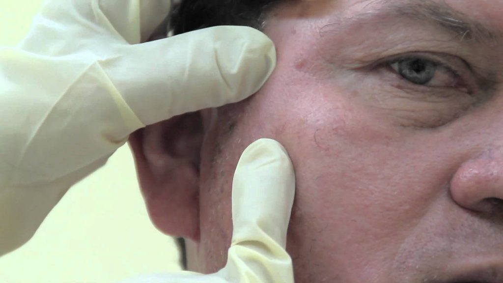 Siete de cada diez casos de cáncer de piel ocurren en el rostro