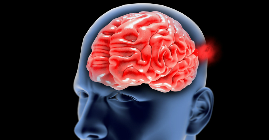 Aneurisma cerebral: el mal silencioso que puede provocar un accidente cerebrovascular