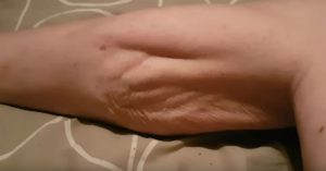 El impresionante video que muestra cómo retuerce los músculos un calambre 