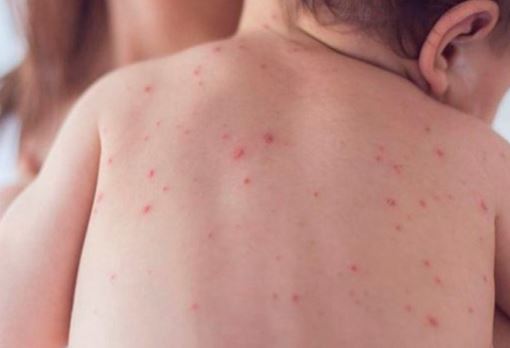 Vacunan contra sarampión a 104 personas que tuvieron contacto con familia francesa contagiada