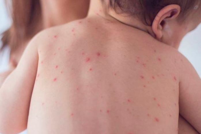 ¡Ya son seis casos! Salud confirma dos niños más con sarampión en familia de estadounidenses
