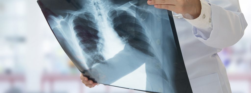 OMS alerta que 511 ticos serán diagnosticados con cáncer de pulmón en 2020