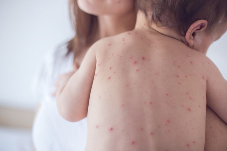Salud recomienda no llevar niños menores de un año a países con brotes de sarampión
