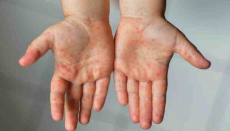 Hospital de Niños registra 32 casos de menores que requirieron atención por síndrome asociado al Covid-19