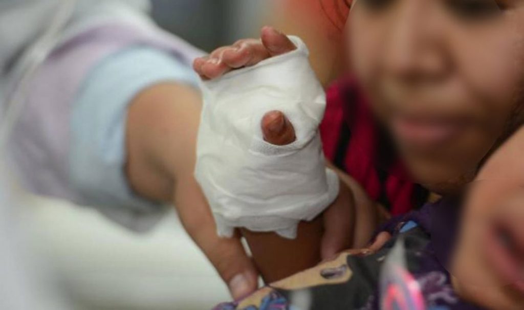 Hospital de Niños eleva alertas por aumento de quemaduras: Suspensión de clases podría incrementar casos