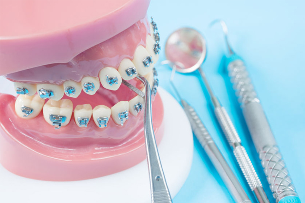 Clínica ULACIT tendrá feria de ortodoncia este sábado con hasta 100% de financiamiento y sin prima