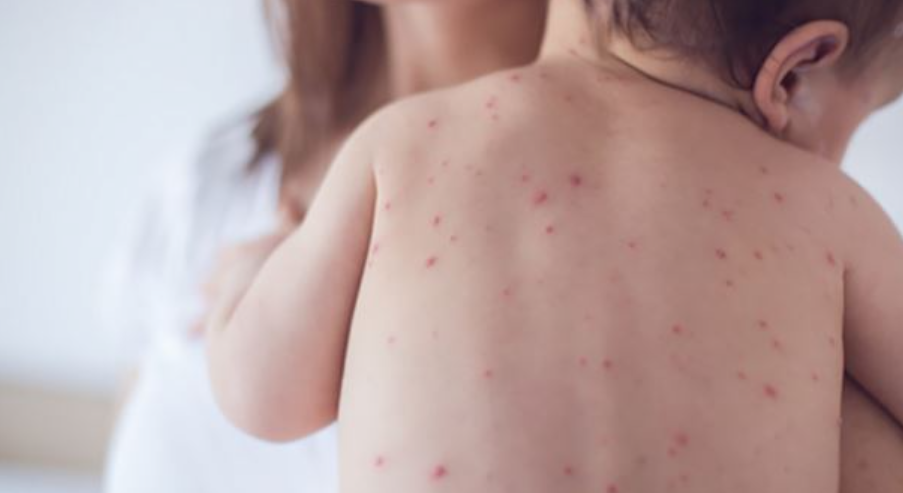 Salud pide extremar medidas para evitar casos de varicela: Se registran más de 600 en el año